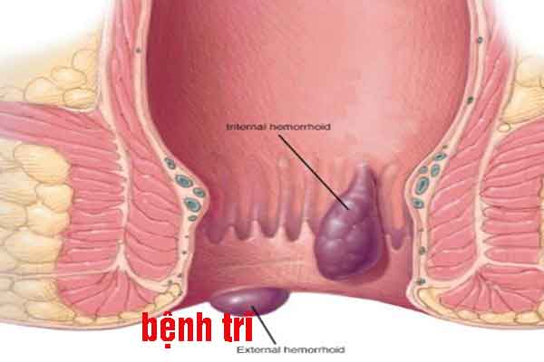 Bị trĩ có đi xuất khẩu lao động được không