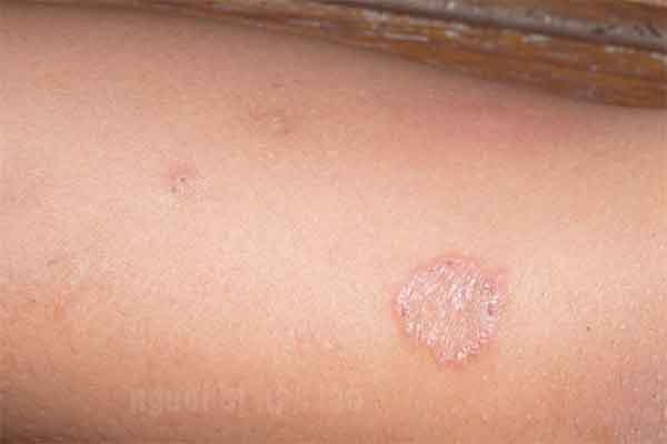 Bị hắc lào có đi Nhật được không