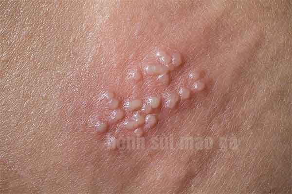 Bị sùi mào gà có đi Nhật được không